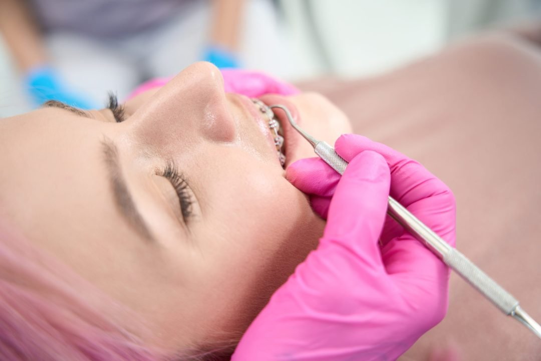 mejores colores de Brackets