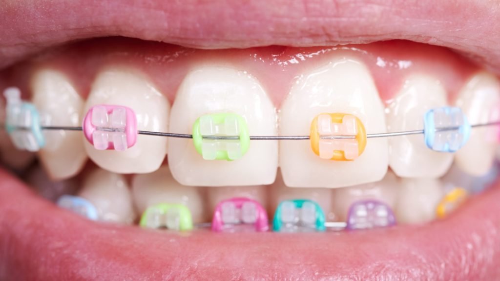 mejores colores de Brackets