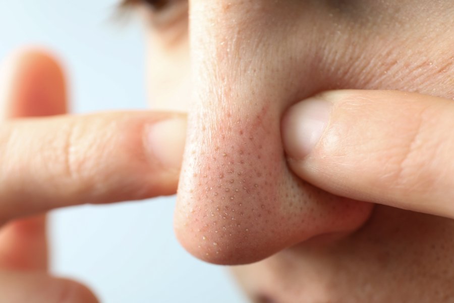Como cerrar los poros de la nariz