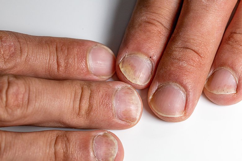 qué dicen tus uñas sobre tu salud