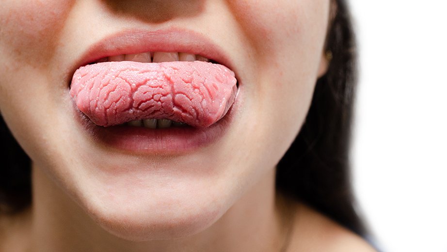 cáncer de lengua