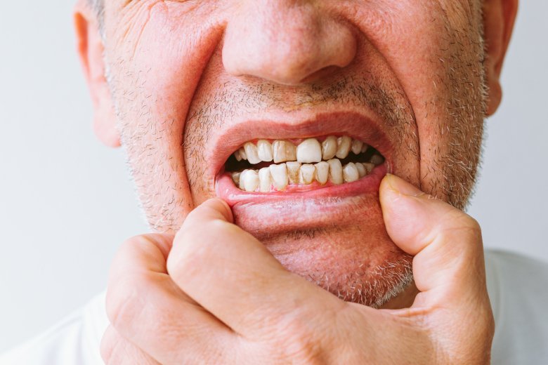 Efectos de no cepillarse los dientes en la noche
